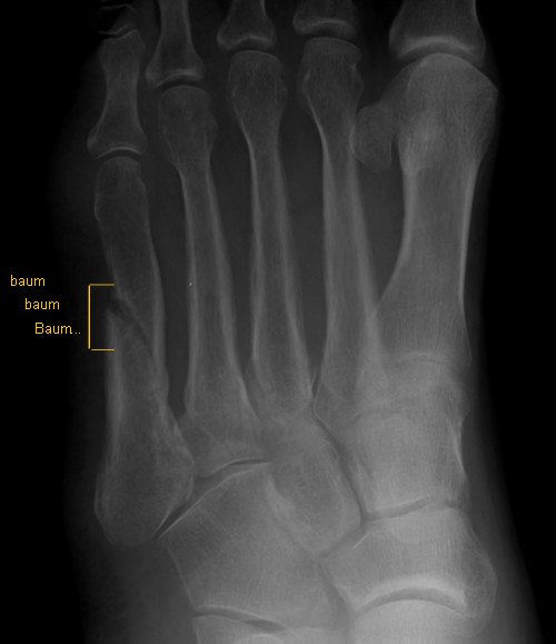 5th metatarsal mid-shaft fracture